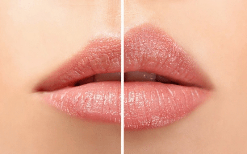 Before and after images showcasing a woman's lips to Get Bigger Lips, highlighting the transformation to fuller lips.